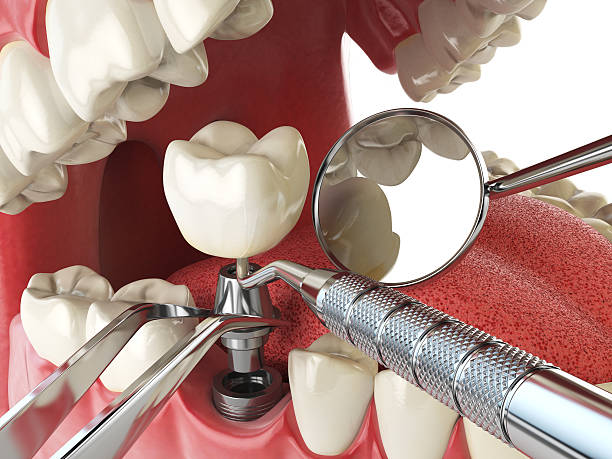 Best Emergency Tooth Extraction in Corcoran, CA